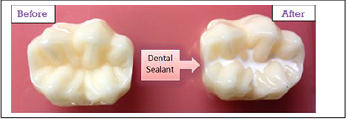 Dental sealant diagram